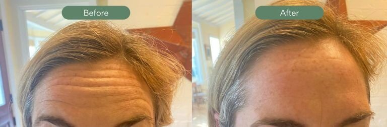 Before and After Botox