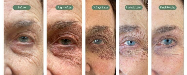 Five photo laser progression