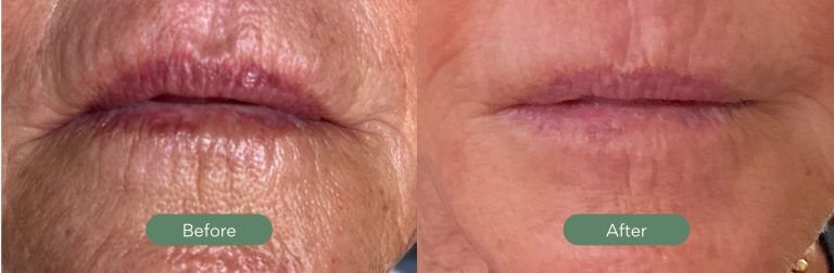 Before and After Laser Treatment
