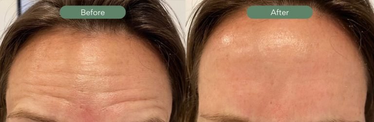 Injected Artistry Before and After Botox