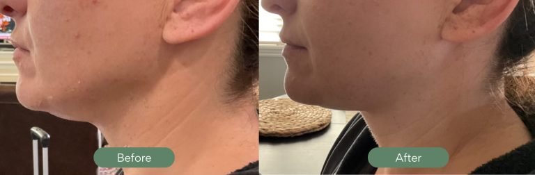 Injected Artistry Before and After Kybella