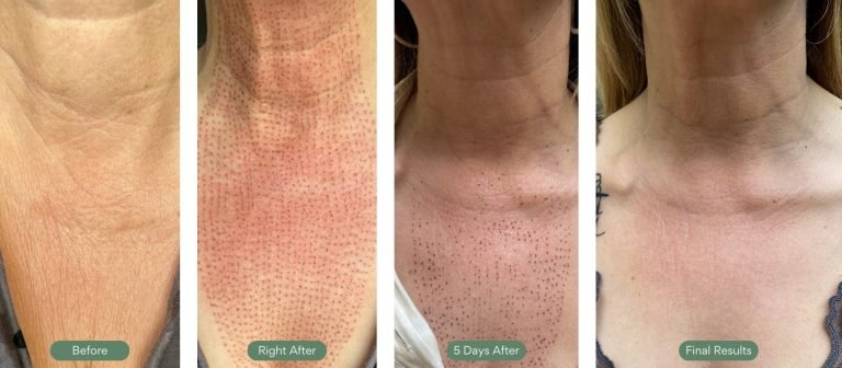 Injected Artistry Fibroblast Plasma Therapy Progression