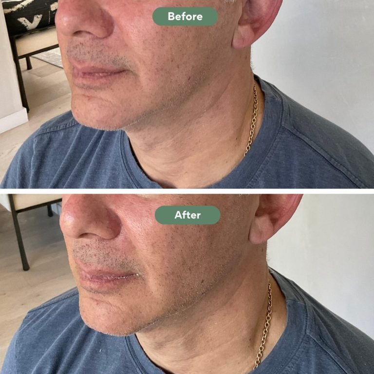 Injected Artistry Jawline Augmentation