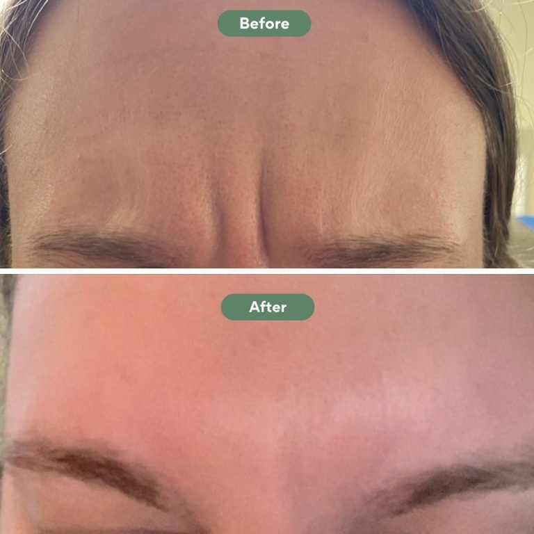 Injected Artistry Botox for Frownlines