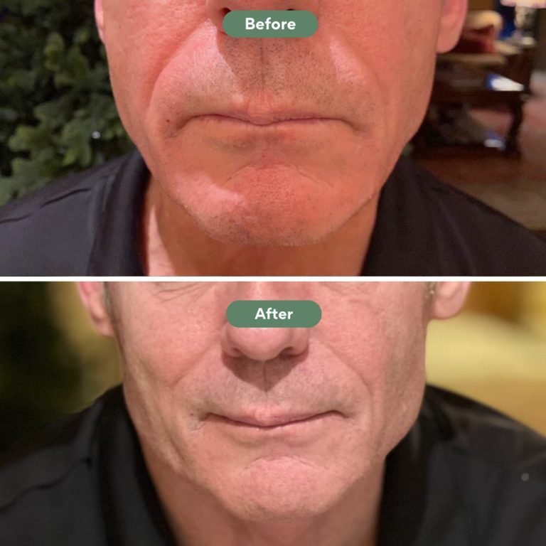 Injected Artistry Jawline Augmentation