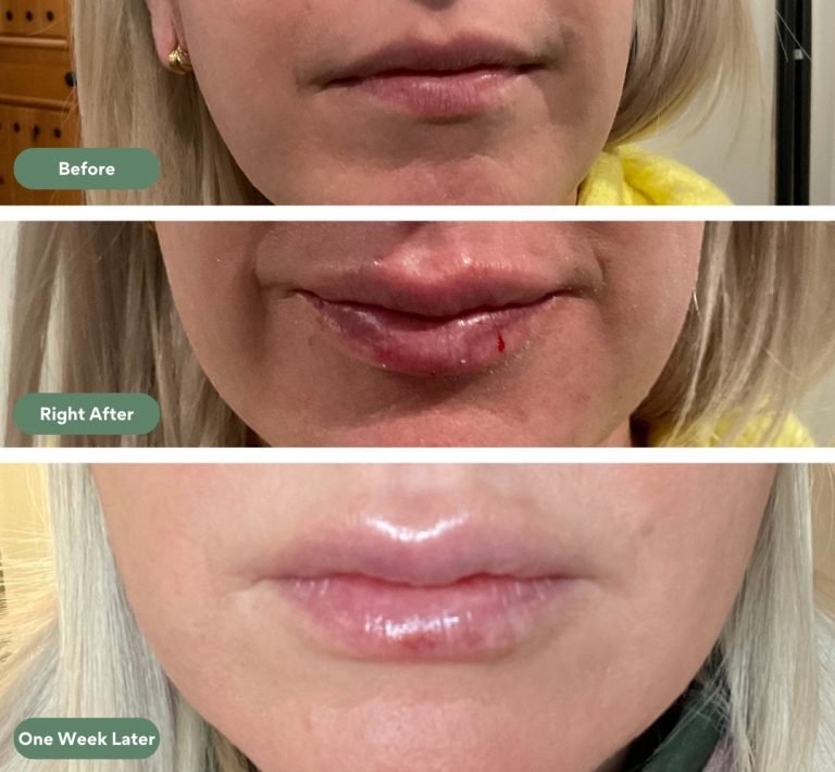 Injected Artistry Lip Filler Augmentation