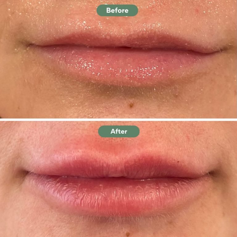 Injected Artistry Lip Filler Augmentation