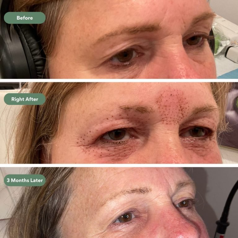 Injected Artistry Subnovii Eyelids