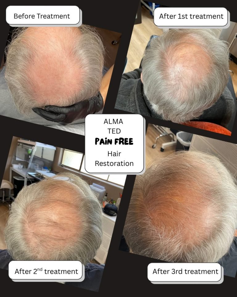 Almated Hair Restoration before and after photos