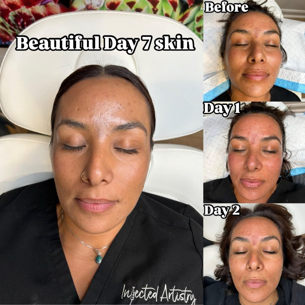 Microneedling Progression Photos
